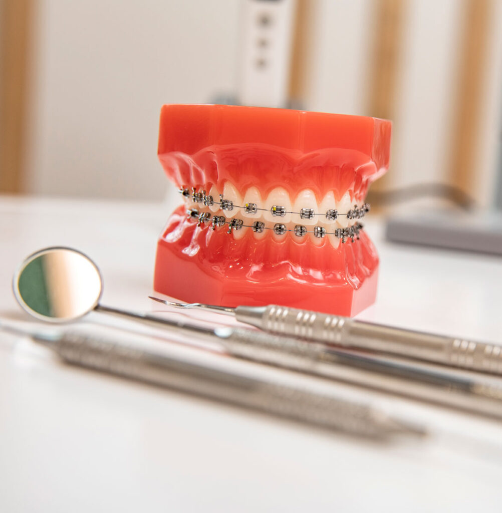 Model of braces on table at Clubhouse orthodontics